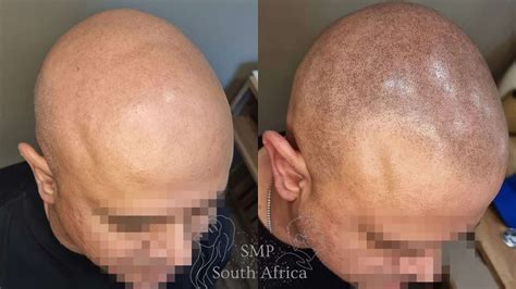 scalp micropigmentation sa|Home .